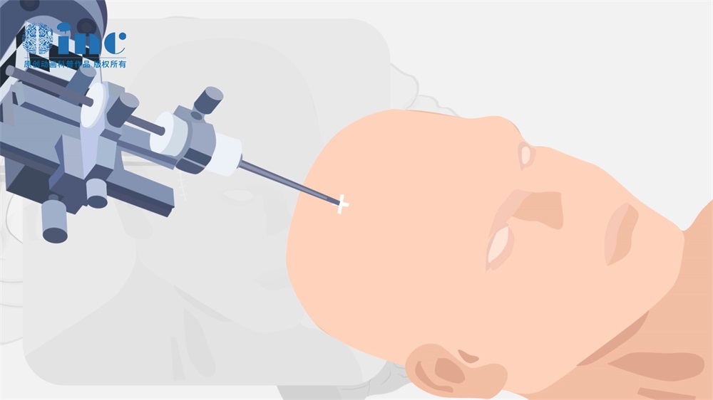 国内BNCT硼中子俘获疗法的现状