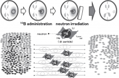 对抗恶性脑肿瘤，硼中子俘获（BNCT）的临床治疗效果解析