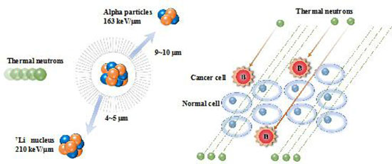 硼中子浮获治疗胶质瘤