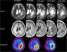 BNCT硼中子俘获治疗间变型星形细胞瘤实例解析