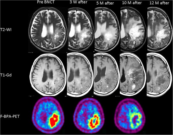 硼中子俘获治疗间变型星形细胞瘤