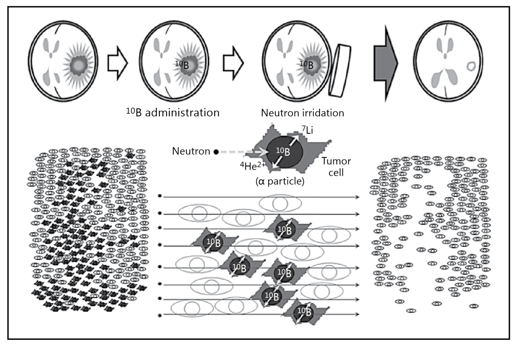 BNCT选择性杀伤癌细胞的原理
