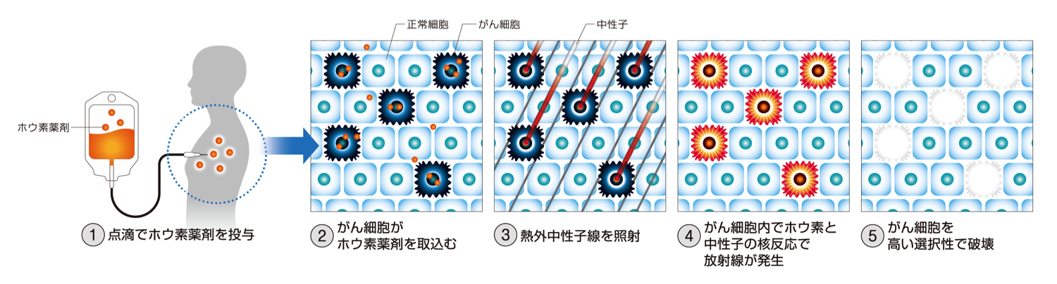 硼中子俘获疗法（bnct）