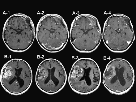 硼中子俘获疗法（bnct）